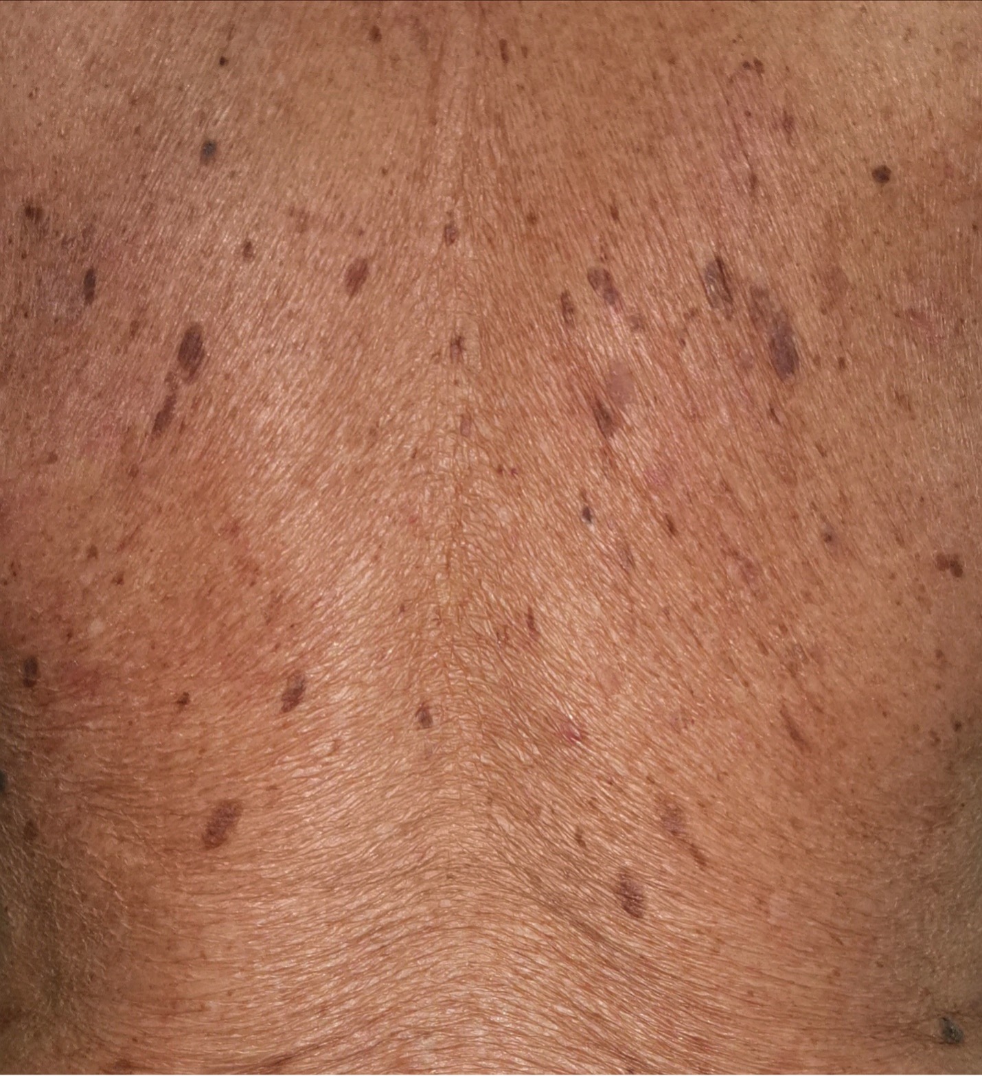 Raised mole on penis